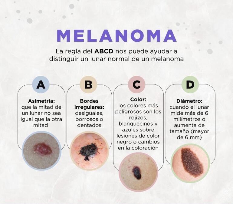 La regla del ABCD puede ayudar a distinguir un lunar normal de un posible melanoma.