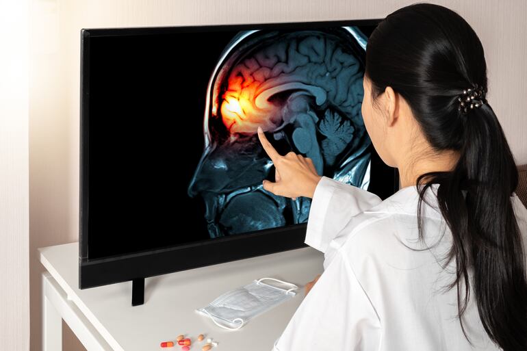 Imagen de referencia: la meningitis se caracteriza por la inflamación de las meninges; la capa que cubre el cerebro.