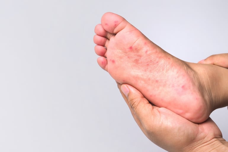 La enfermedad de manos, pies y boca es muy contagiosa y afecta principalmente a niños menores de cinco años, advierten.