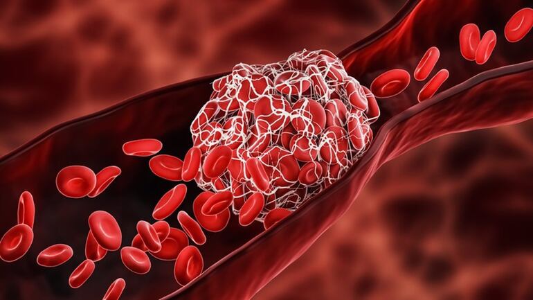 La forma de las cavidades del corazón y la inclinación con la que llegan las venas pulmonares pueden condicionar el riesgo de sufrir trombos sanguíneos en el corazón entre pacientes con fibrilación auricular, el tipo de arritmia más frecuente, y una de las principales causas de los trombos.