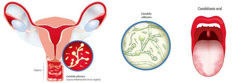 Moniliasis o candidiasis.