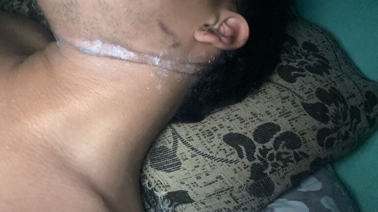 Junior Méndez (17) quedó con heridas en el cuello a causa del cable suelto.