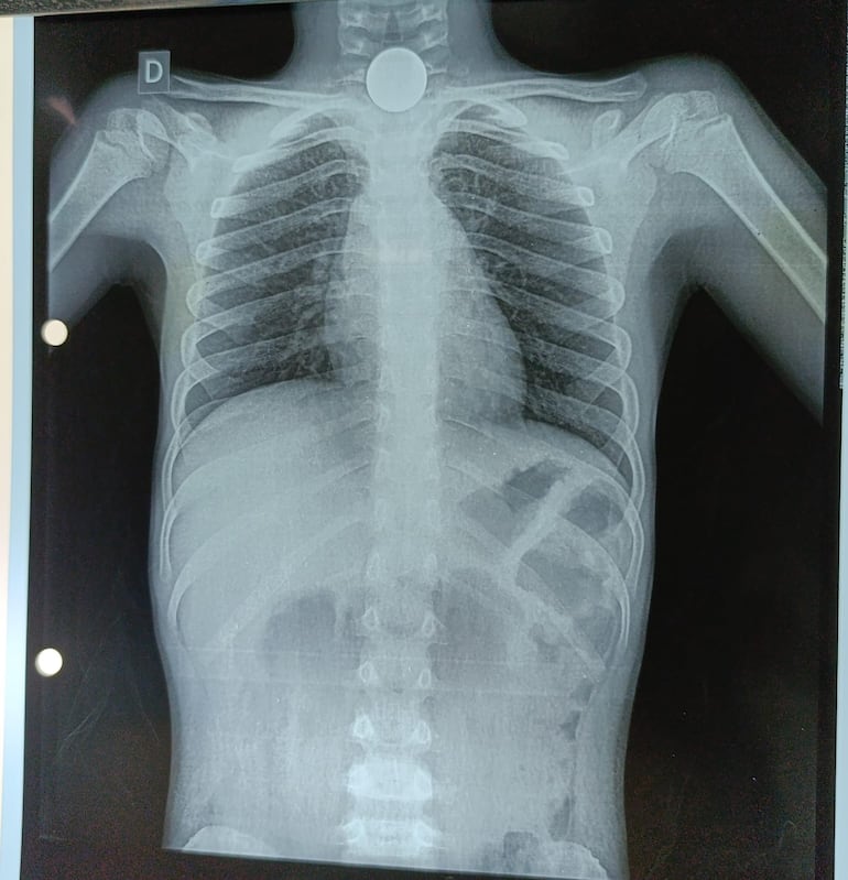 Radiografía al niño en el que se observa la moneda entre la garganta y el esófago. (gentileza).