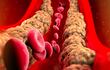 Formación de colesterol en una vena. Akira Endo, un investigador japonés que trabajó en el desarrollo de las estatinas, un grupo de fármacos usados para disminuir el colesterol, ha fallecido a los 90 años, según revelaron este martes sus familiares a medios locales.