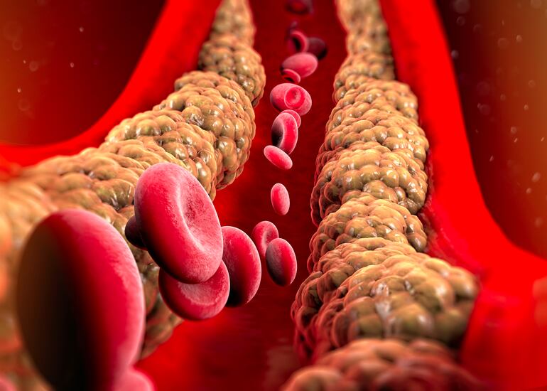 Formación de colesterol en una vena. Akira Endo, un investigador japonés que trabajó en el desarrollo de las estatinas, un grupo de fármacos usados para disminuir el colesterol, ha fallecido a los 90 años, según revelaron este martes sus familiares a medios locales.