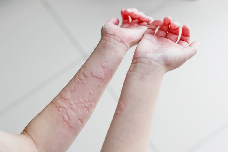 Urticaria.