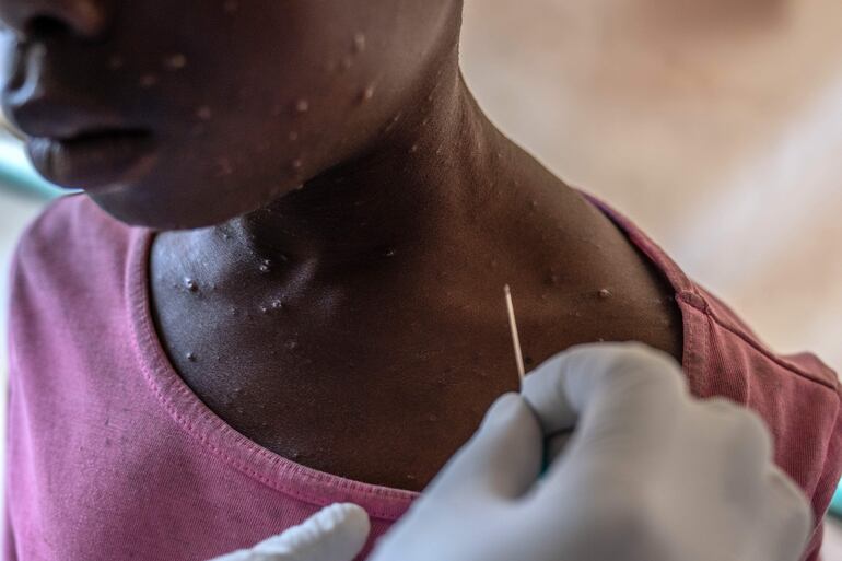 Un chico recibe tratamiento para el mpox en el Centro de Salud de Munigi, en la República Democrática del Congo.