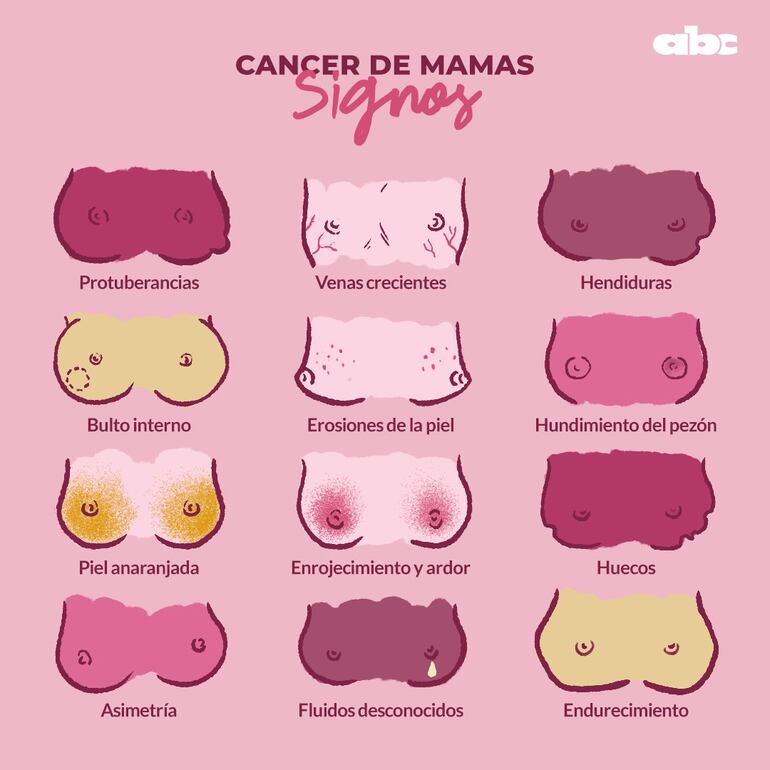 Signos del cáncer de mamas.