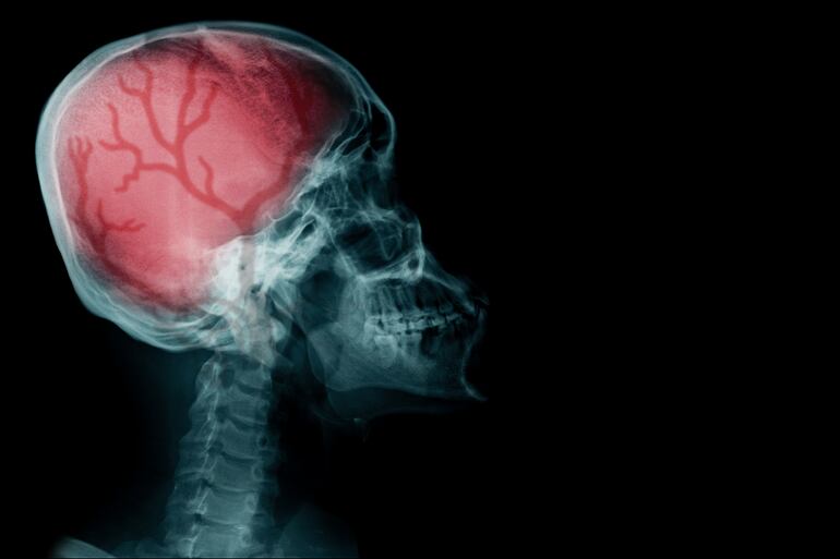 Accidente Cerebro Vascular (ACV)