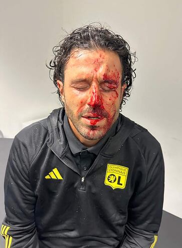 Así quedó el rostro de Fabio Grosso, el DT italiano del Lyon, tras los ataques de los hinchas del Marsella.