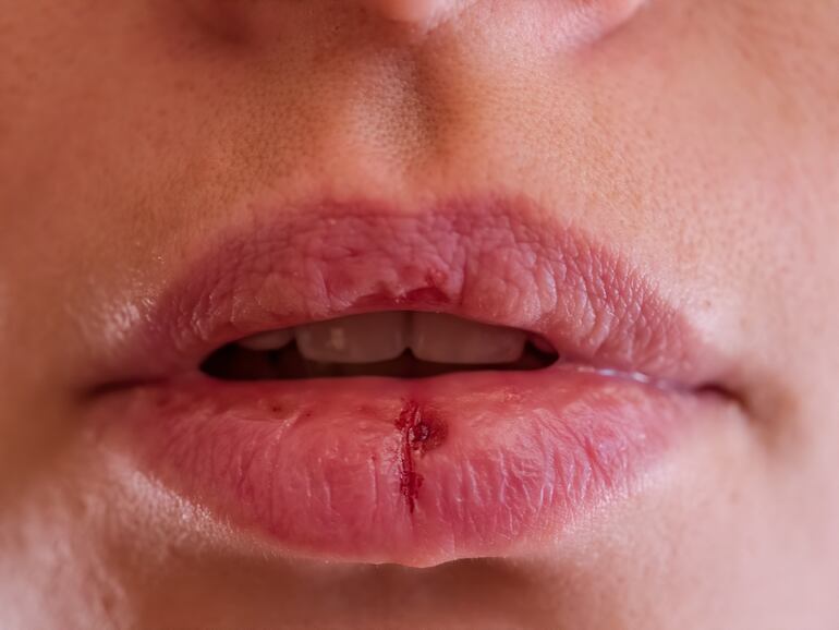 Labios de mujer quebradizos, resquebrajados y secos por efecto del frío.