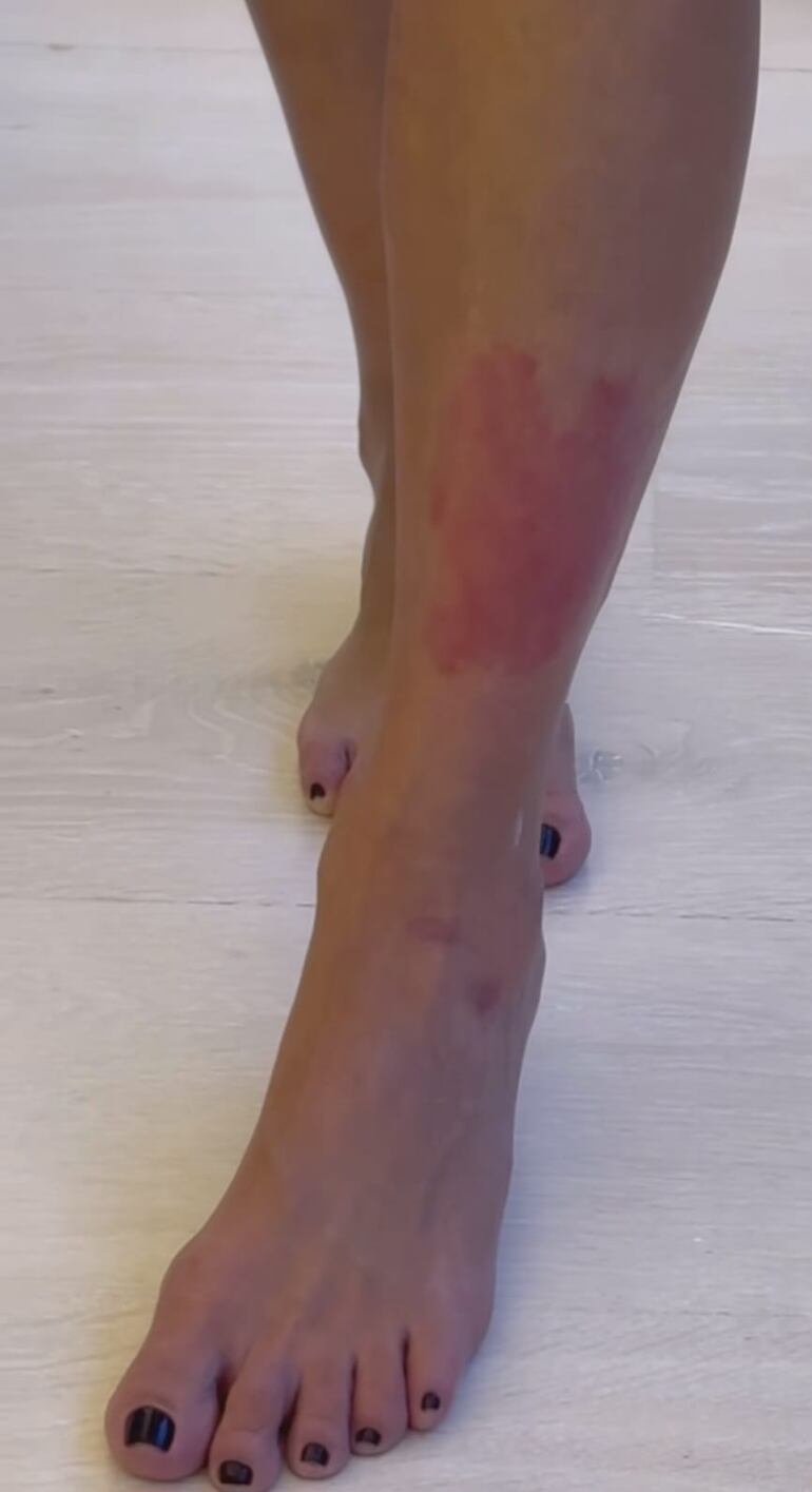 Kim Kardashian mostró cómo se ve su pierna con psoriasis. (Instagram/Kim Kardashian)