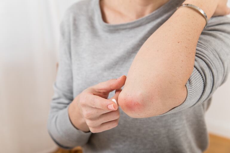 Los enfermos de psoriasis no solo deben cuidar su piel, sino también su psiquis.