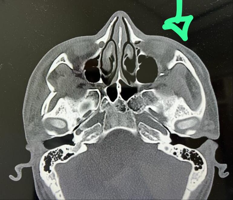 Fractura de arco cigomático.