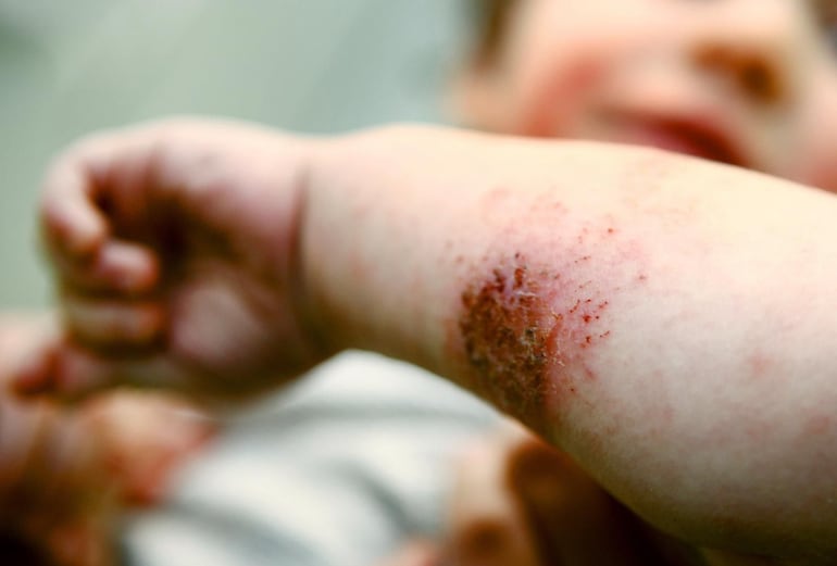 La dermatitis atópica puede limitar la calidad de vida, afirman especialistas.