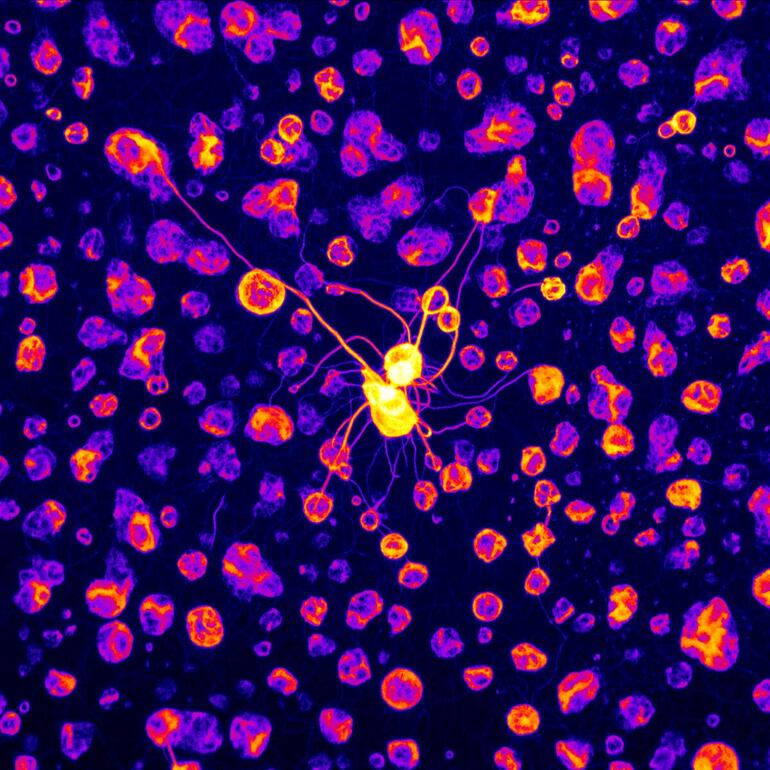 Un equipo científico español del Instituto de Investigación Biomédica (IRB Barcelona) identificó un mecanismo molecular que explica por qué ciertas alteraciones en la proteína neuronal CPEB4 están asociadas con el autismo idiopático o de causa desconocida.