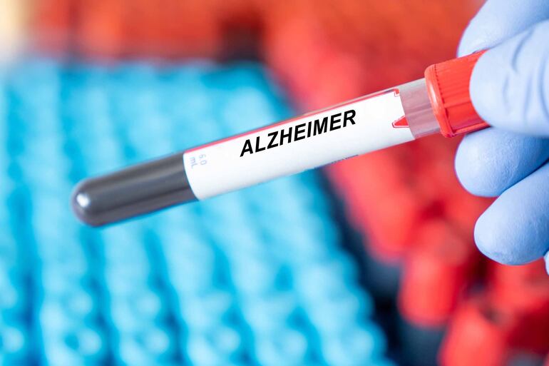 Tubo de laboratorio con muestra de sangre y una etiqueta de Alzheimer