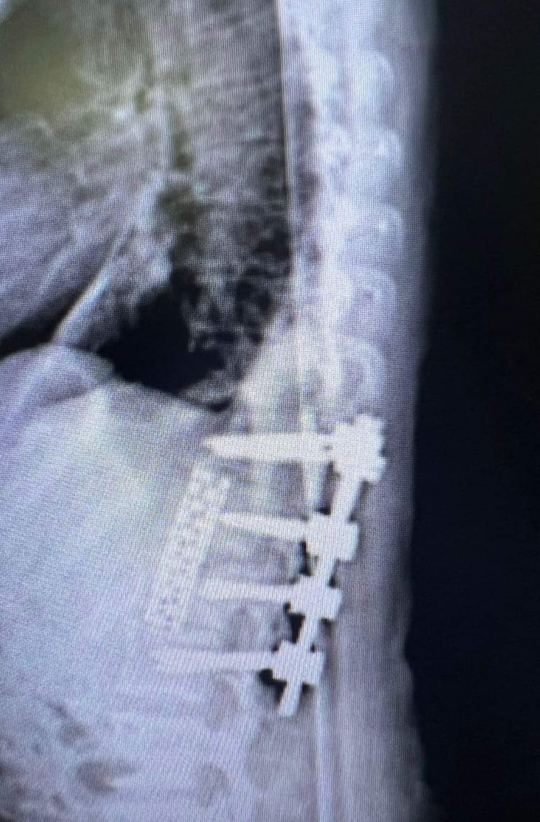 Placa de paciente, fijación lumbar de las vértebras L1 y T12.