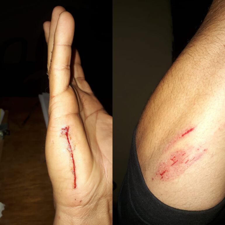 De esta manera quedo la mano y el brazo del suboficial mayor Ever Jara, tras forcejear con Matías Rivarola, según menciono Arnaldo Leguizamón, subjefe de la comisaria Primera de San Juan Bautista, Misiones.