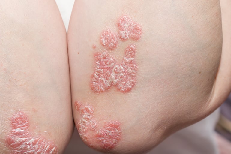 Codos con psoriasis