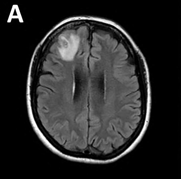 Una resonancia magnética muestra la lombriz viva en el cerebro de la paciente. 