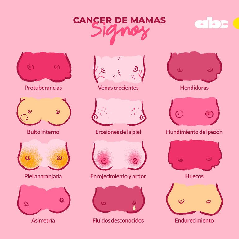 Signos del cáncer de mama. 