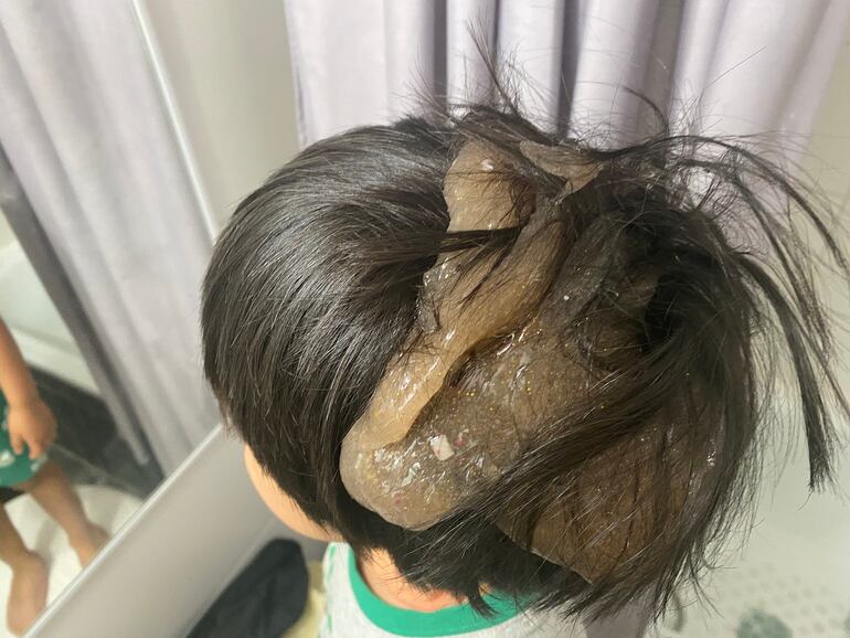 Niño con problemas en el cabello a causa del slime. (Fuente X Dr. Robert Nuñez